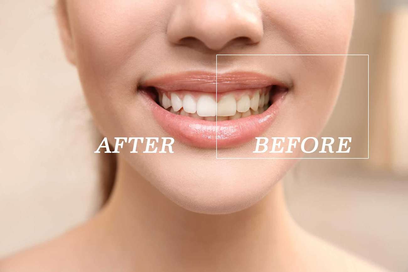 How Can You Maintain a Consistent Smile Shade with Crowns Chelmsford?