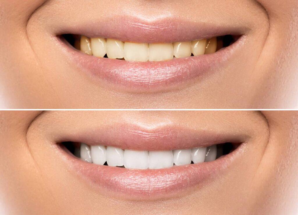 How Does Gum Disease Progress if Left Untreated Chelmsford?