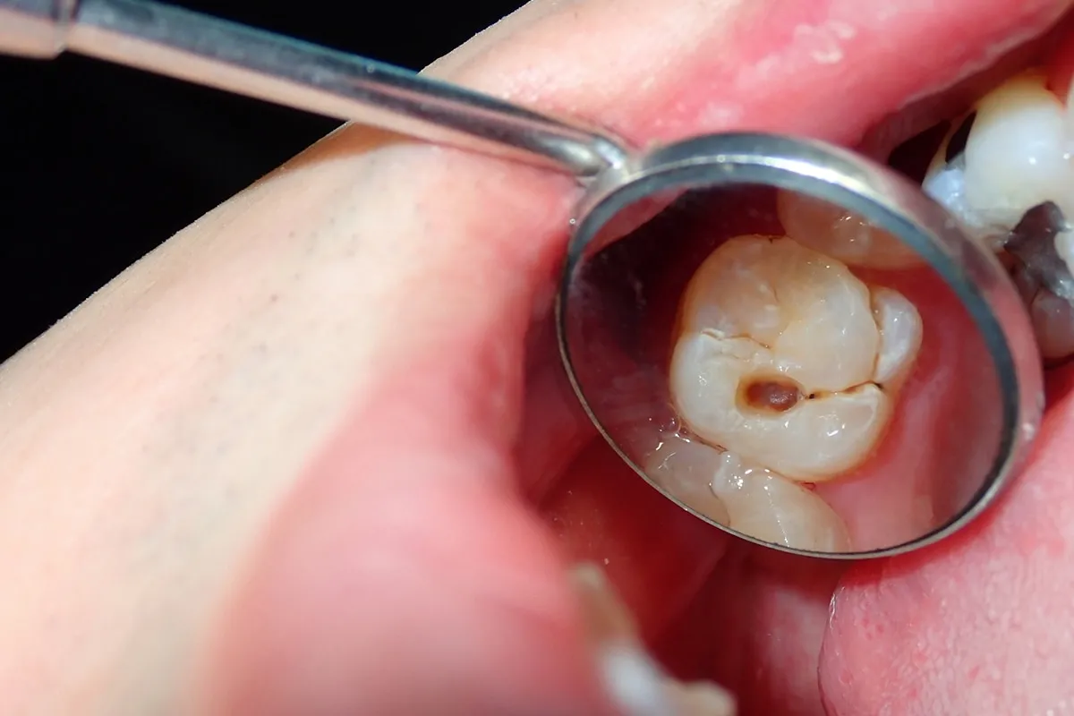 Why Do Teeth Crack? Common Causes to Know Chelmsford