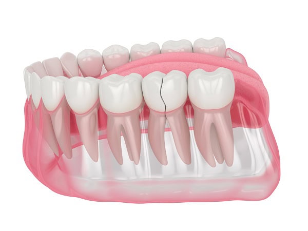 How Can You Manage Pain and Discomfort After a Root Canal Chelmsford?
