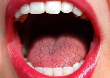 Common Causes of Dry Mouth (Xerostomia) Chelmsford
