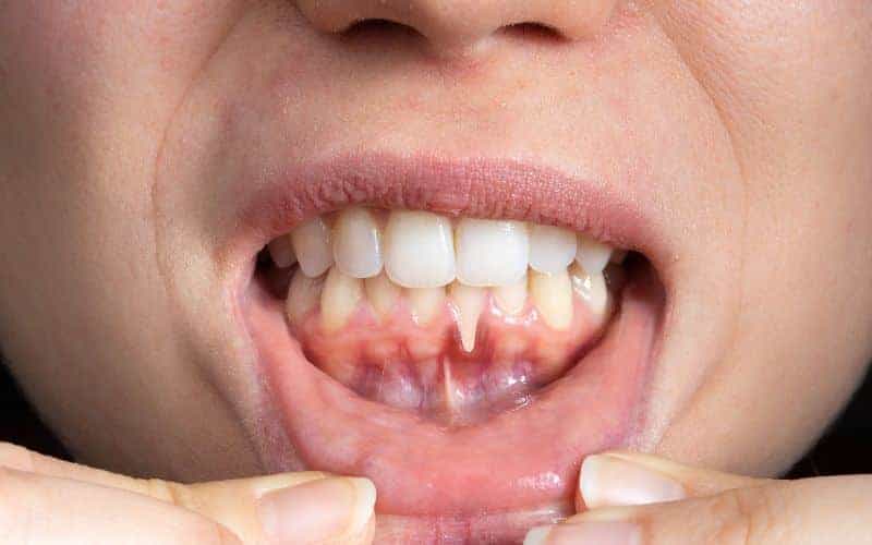 How Can Gum Disease Be Prevented Chelmsford?