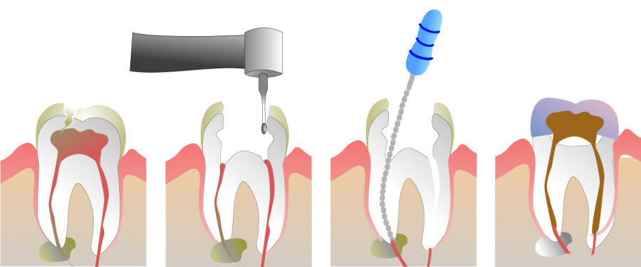How Do You Properly Care for Your Teeth After a Root Canal Chelmsford