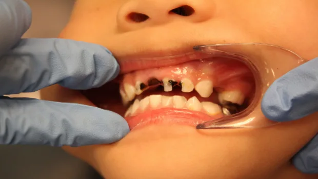 Tips for Keeping Your Child’s Baby Teeth Healthy and Strong Chelmsford