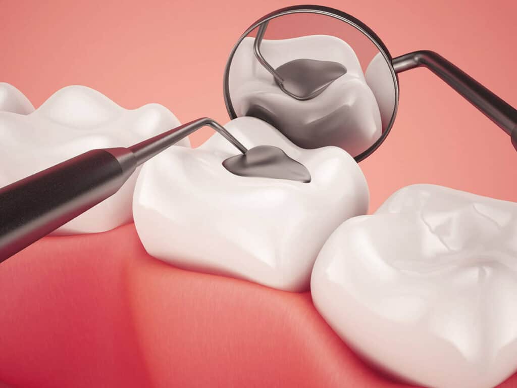 Fighting Cavities and Plaque Buildup Chelmsford