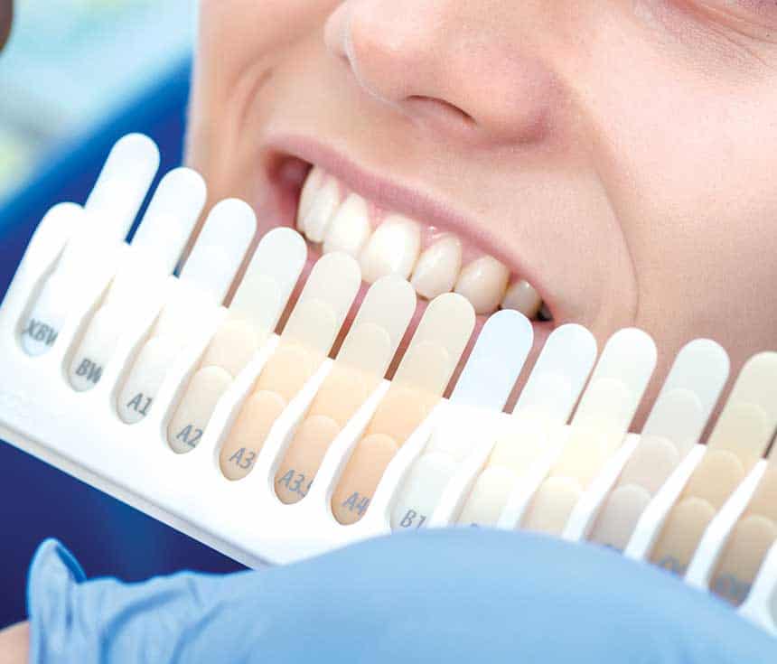 Professional vs At-Home Whitening: What You Need to Know Chelmsford