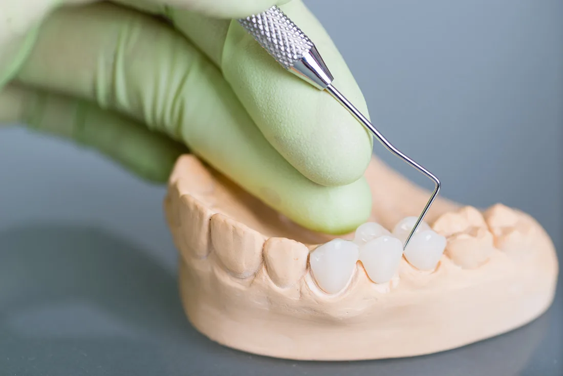 Do Braces Take Years to Show Results Chelmsford