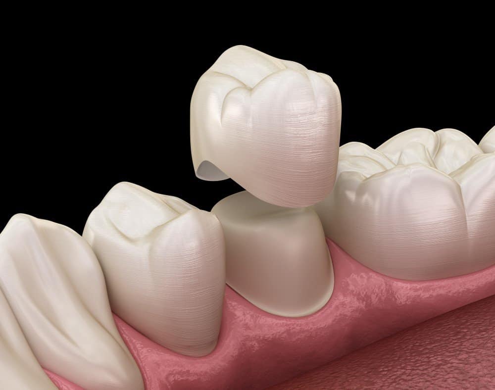 Teeth Whitening: Separating Facts from Fiction Chelmsford