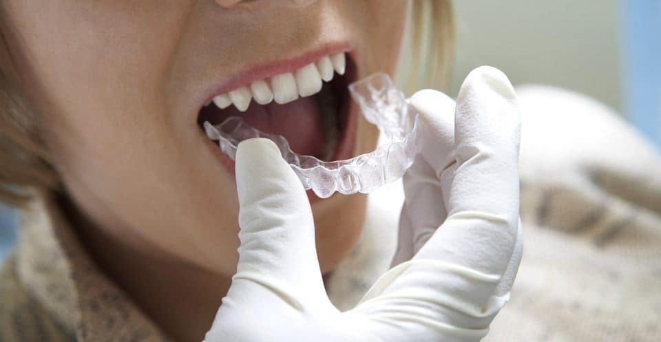 Can Bruxism Affect Your Sleep Quality Chelmsford