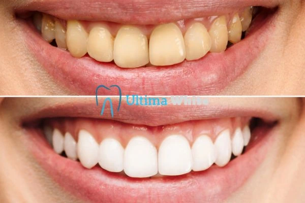 Oral Care Tips for Current and Former Smokers Chelmsford