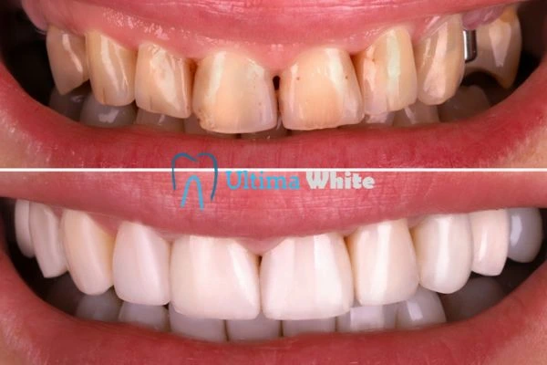 What Makes Instant Teeth Whitening Treatments So Popular Chelmsford?